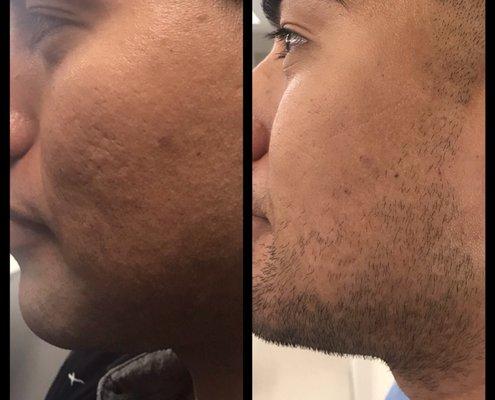 Before and after- one session Microneedling with PRP