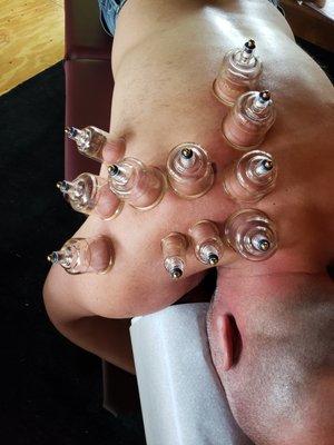 Northlake Wellness offers cupping.  Cupping is great for chronic tight muscles and old injuries.