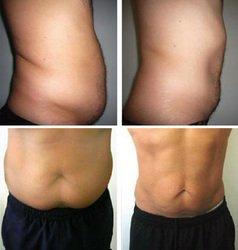 Before and after ultrasonic cavitation