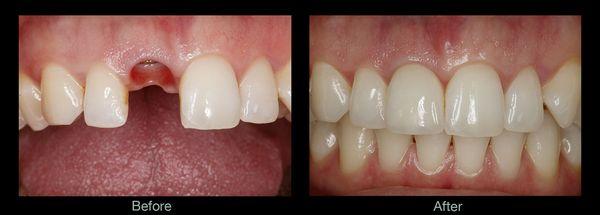 Single tooth replacement with an implant