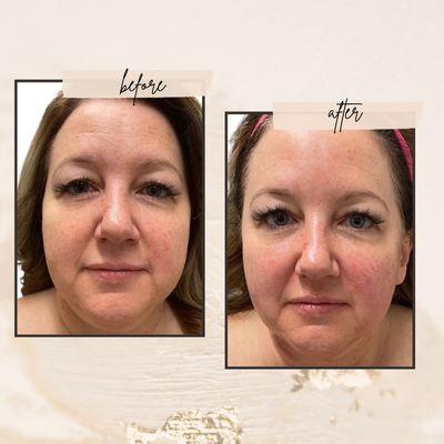 Check out our Chin and Face Sculpt treatment.