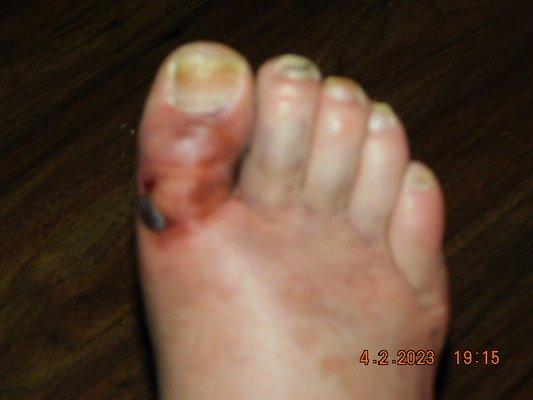 I broke my right toe bone split in middle has black and blue they said takes 8 weeks for toe get heeled soon