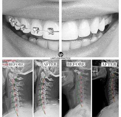 Alignment is important and takes time. Spinal hygiene is important and necessary.