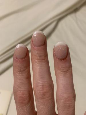 The other cuticles that had been cut, also two days after the manicure