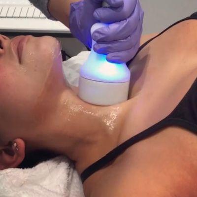 Cryoskin Facials - all the results of botox and fillers without the needles