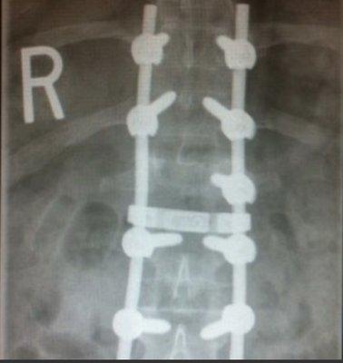 My fused back