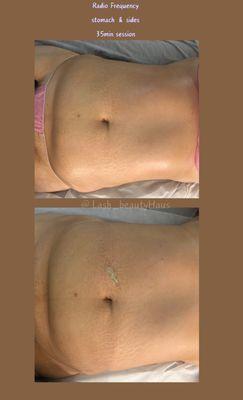 Stomach & Sides Body Sculpting