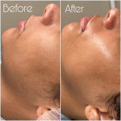 Dermaplaning before and after