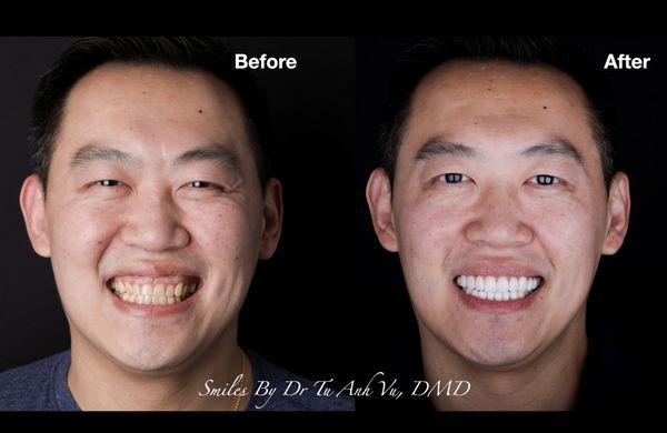 Smile Makeover case by Dr. Vu