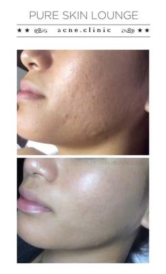 Your treatment at the Acne Clinic is guided by an acne expert; your Personal Skin Coach!