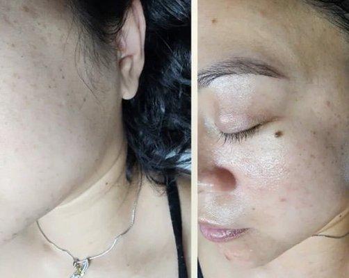 My before and after hydroglow with dermaplane.