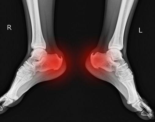 Heel Spurs, Plantar fasciitis and Achilles tendonitis