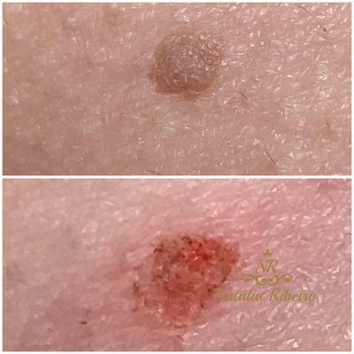 Skin tag removal