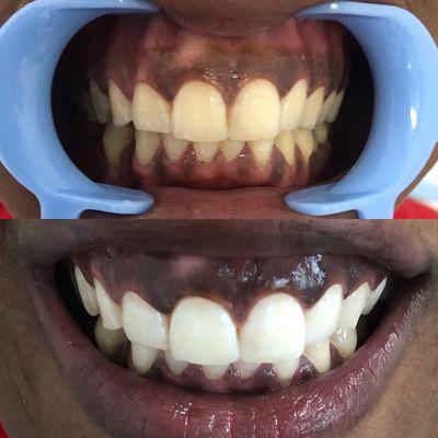 60 minute teeth whitening