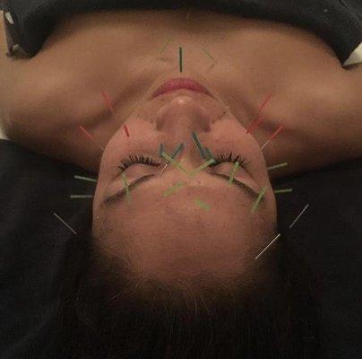 Facial Acupuncture boosts collagen, lifts and releases muscle tension.