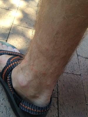 Bedbugs bites on other ankle.