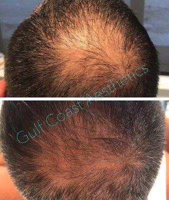 Hair restoration treatments on a male experiencing hair thinning and bald patches.