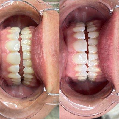 Before/after teeth whitening