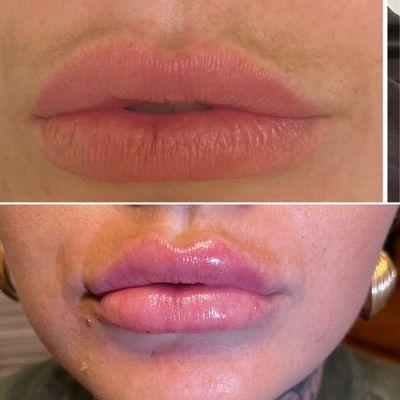 Revanesse lips dermal filler.