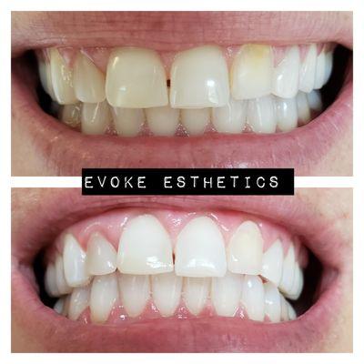 Organic Teeth Whitening Before & After.