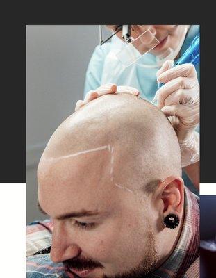 Scalp Micropigmentation