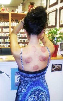 Cupping aftermath.