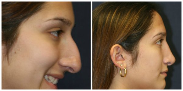 Dr. Reddy performed a septoplasty and rhinoplasty.