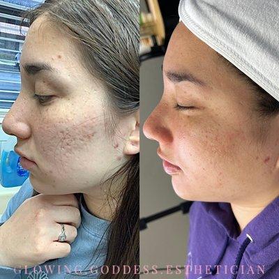 Microneedling , acne scarring