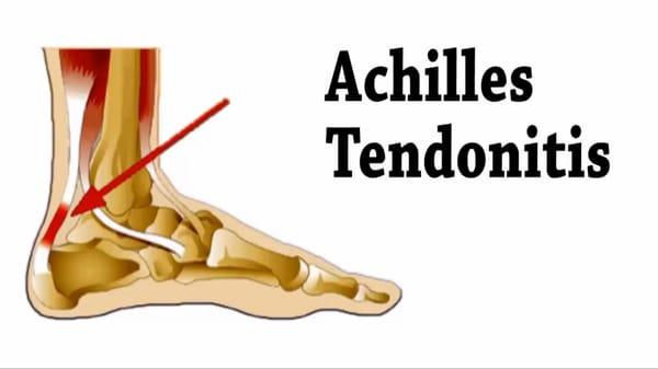 Treating Achilles Tendonitis at Adler Footcare