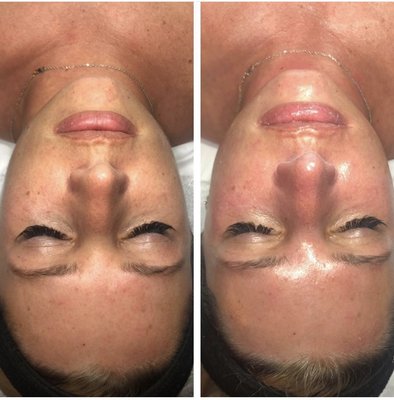 Before and After Dermaplaning and  Hydrafacial