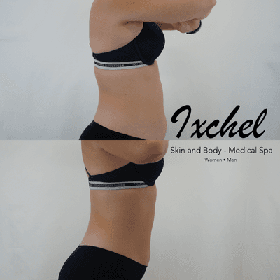 1 truSculpt and 4 truFlex sessions