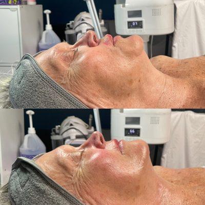 Oxygen facial with lymphatic massage