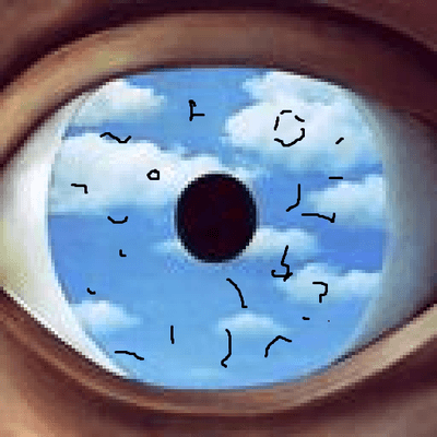 Floaters require a prompt evaluation especially if associated with flashing lights. This may indicate a retinal tear or retinal detachment