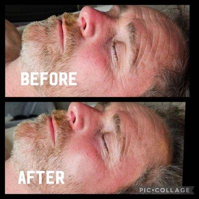 Before and after custom treatment facial