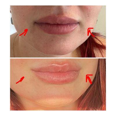 Lip fillers and lifting of the corners of the mouth with botox