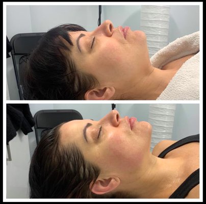 A non invasive treatment that reduces the appearance of double chin.