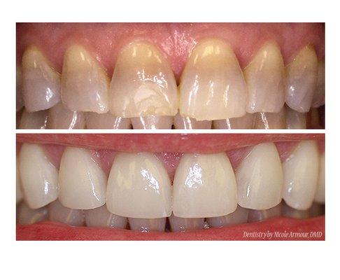 Veneers by Dr. Armour