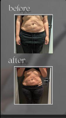 Fat cavitation/Radio Frequency Skin Thightening
Combo results after 6 session