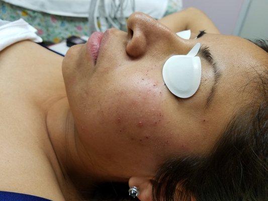 Treatment Acne,Pimples and spot.