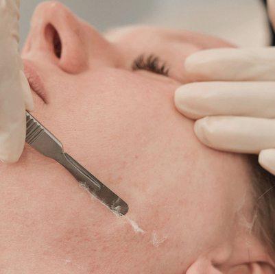 Dermaplane facial