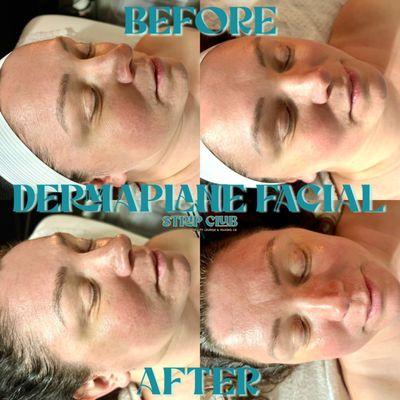 Dermaplane facial.