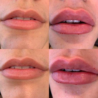 Lip augmentation