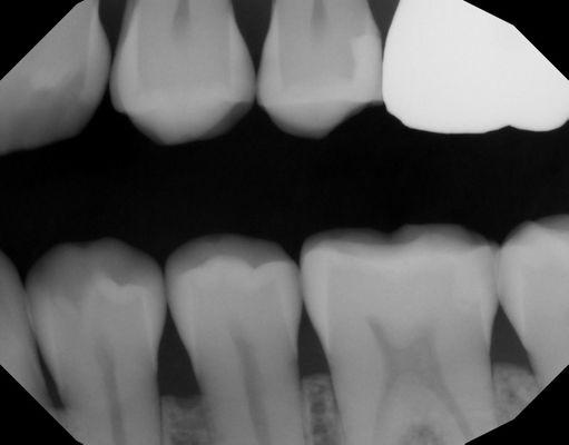 X-Rays of the teeth before Dr. Patel "Treatment"