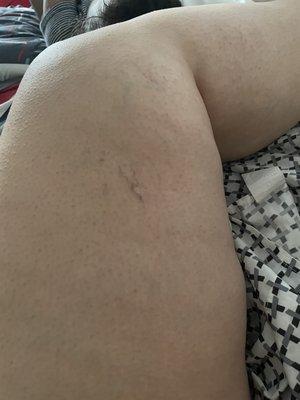 After results you see my spider veins still there!