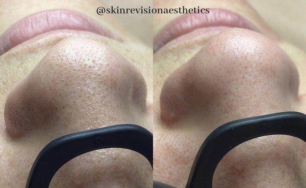 Before and after from unclogging the pores on the nose