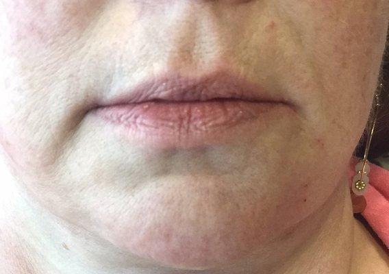 Left corner of lip and chin post filler injection correction, Right side not yet corrected.