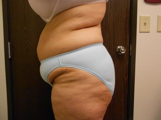 Cativation Lipo Before