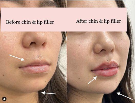 Chin and lip filler, lip flip