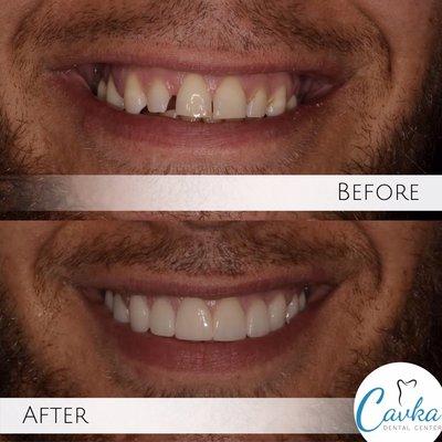 Veneer smile makeover