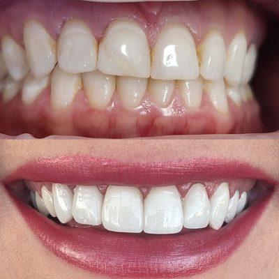 Before and after cosmetic crowns by Dr. Wilson.